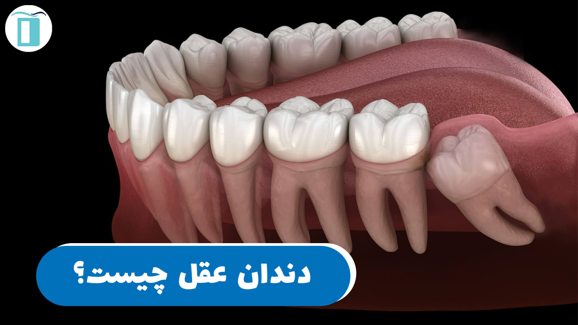 دندان عقل چیست؟ تصویر دندان عقل