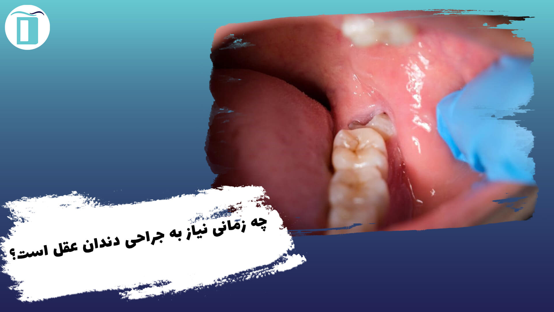 چه زمانی باید دندان عقل را جراحی کرد؟