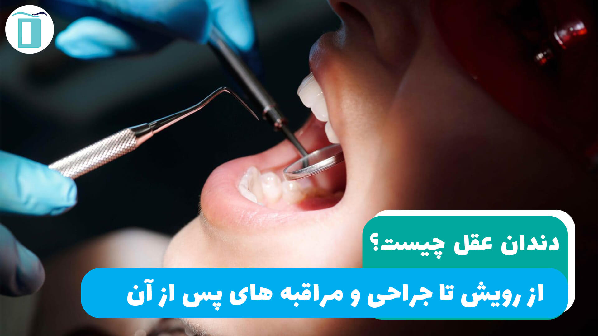 دندان عقل چیست ؟ از رویش تا جراحی و مراقبه های پس از آن.
